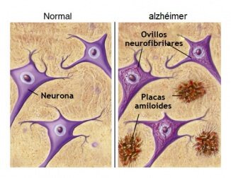 alzheimer sintomi