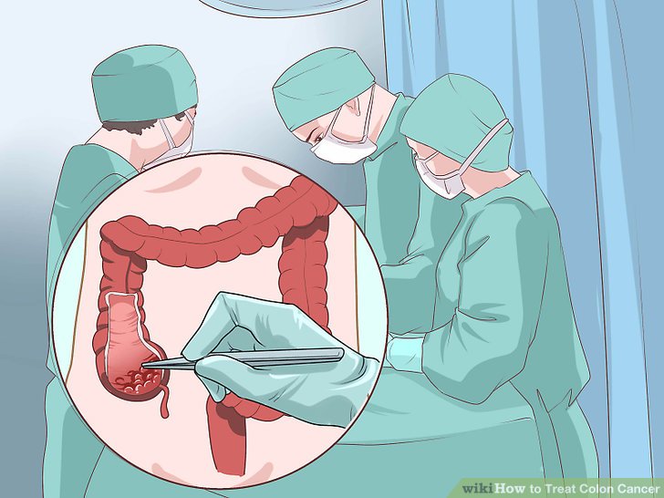 tumore al colon