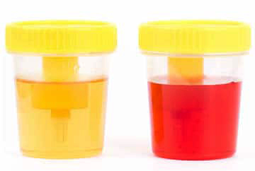 Sangue nelle urine