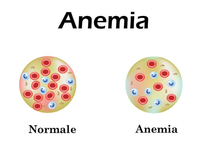 Anemia: Cause, rischi, dieta e come trattarla in tempo