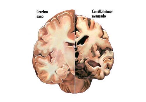 13 alimenti per rallentare e prevenire il morbo di Alzheimer