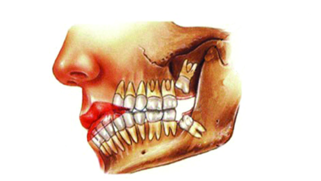 Denti del giudizio: Perchè bisogna estrarli? Quanto costa l'operazione?