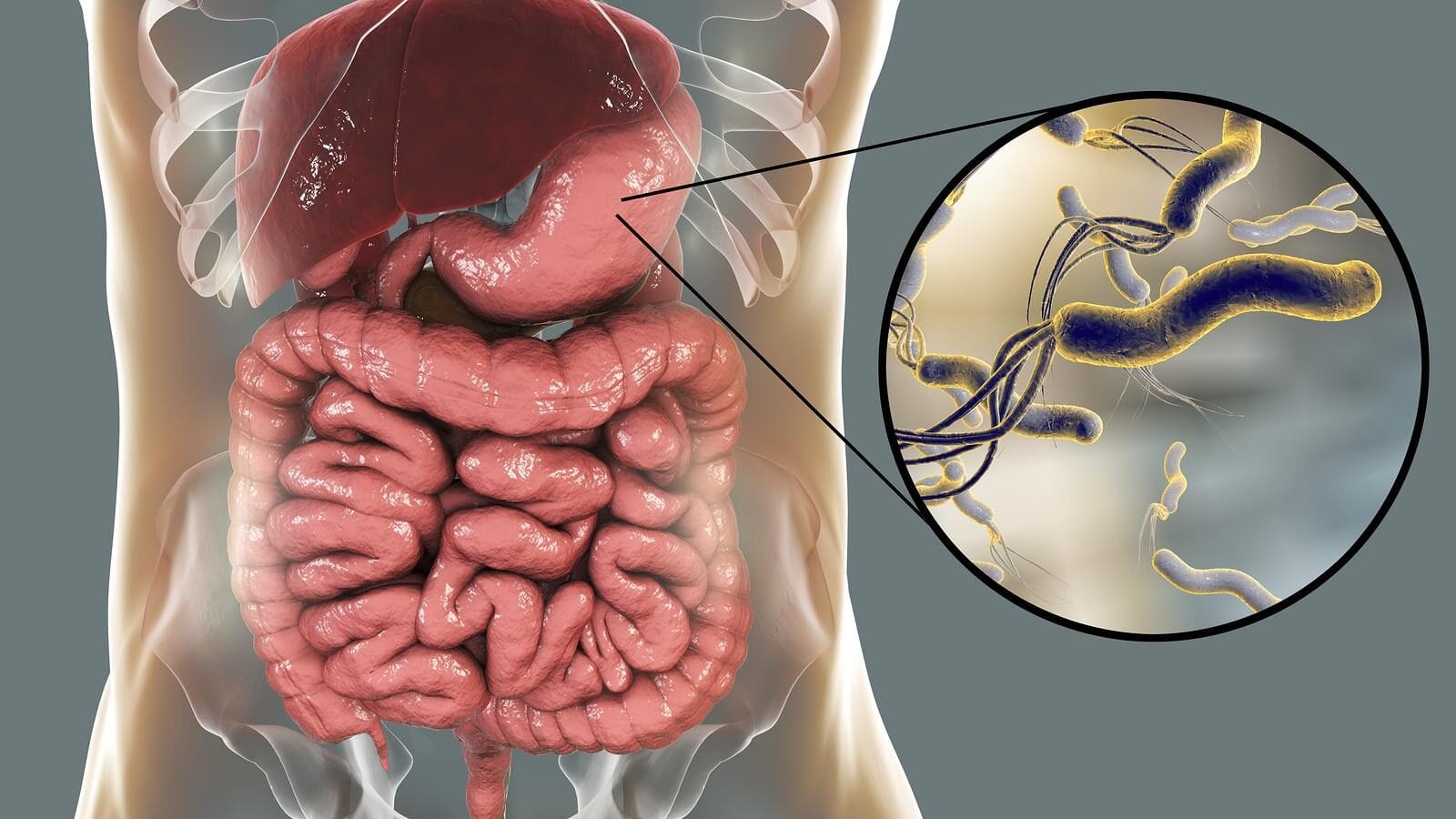 helicobacter pylori